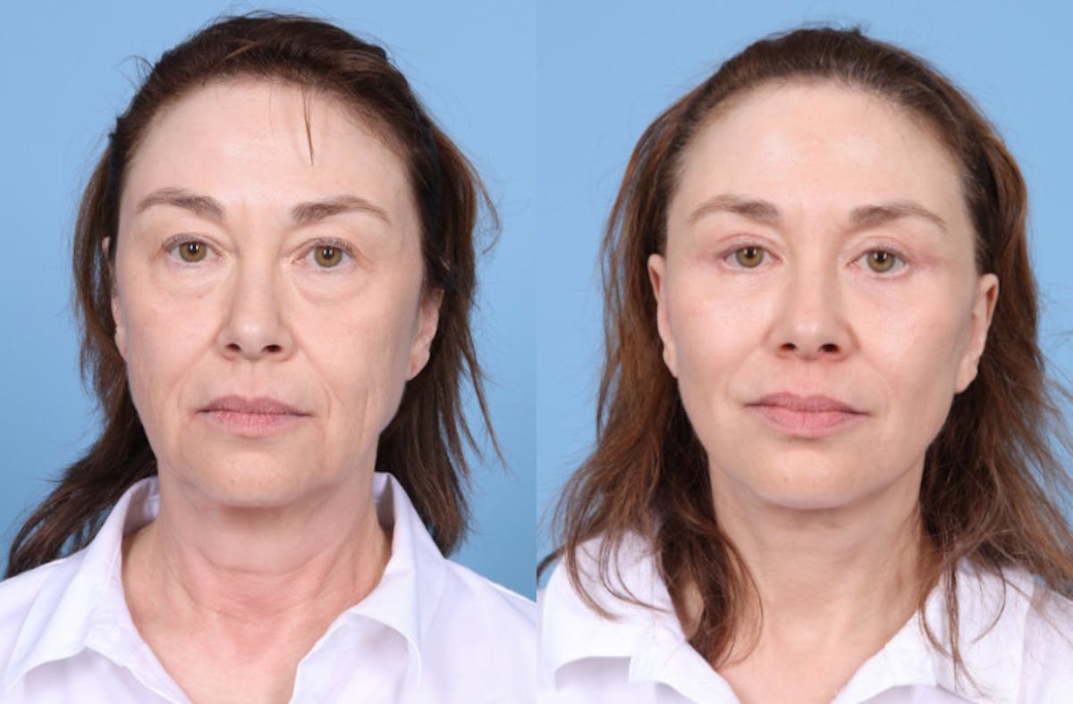 Neck Lift Before & After Gallery - Patient 905074 - Image 7