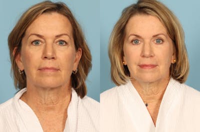 Skincare Before & After Gallery - Patient 149210 - Image 1