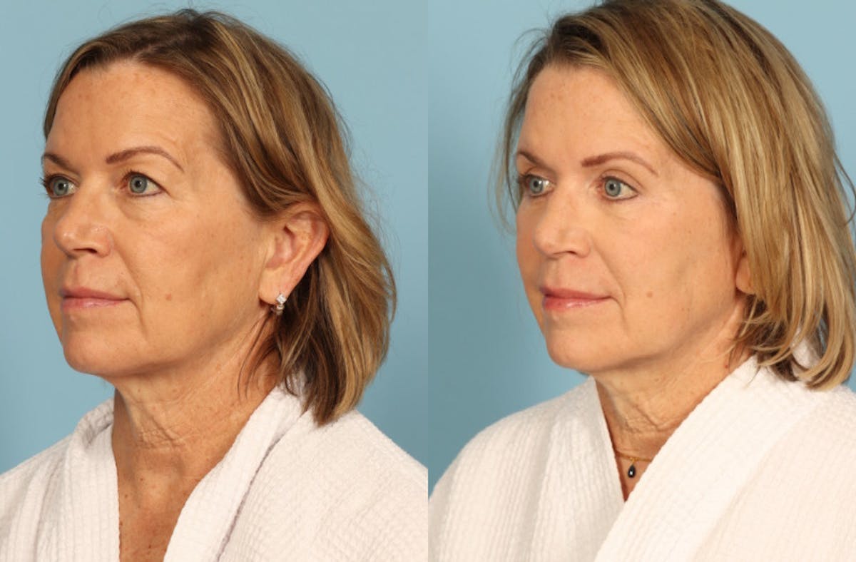 Skincare Before & After Gallery - Patient 149210 - Image 2