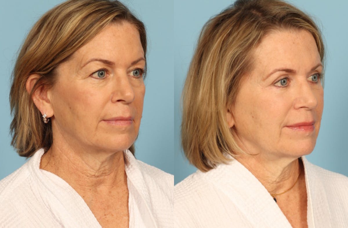 Skincare Before & After Gallery - Patient 149210 - Image 3