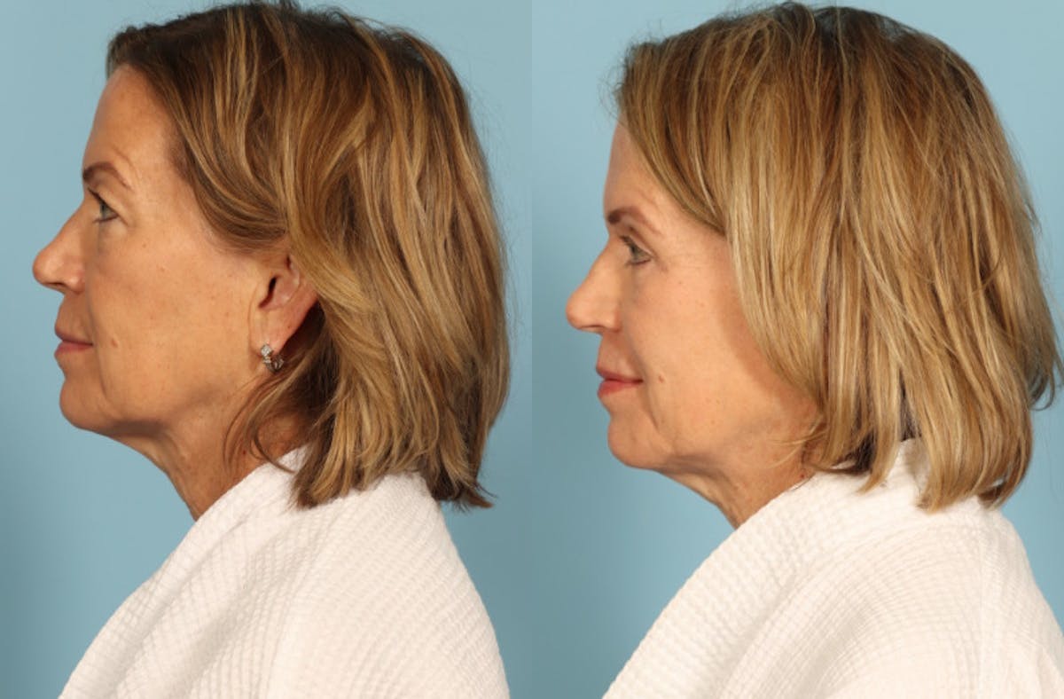 Skincare Before & After Gallery - Patient 149210 - Image 4