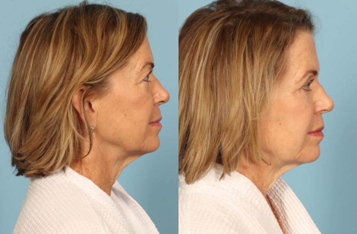 Skincare Before & After Gallery - Patient 149210 - Image 5
