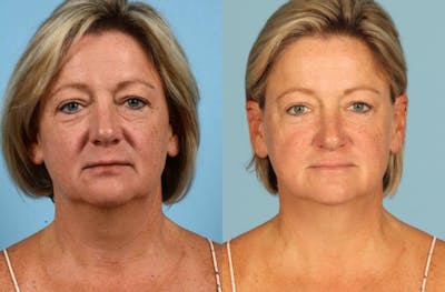 Midface Lift Before & After Gallery - Patient 391939 - Image 1