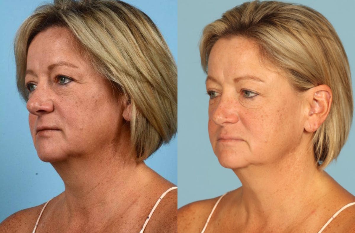 Midface Lift Before & After Gallery - Patient 391939 - Image 2