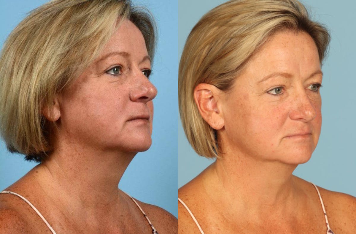 Midface Lift Before & After Gallery - Patient 391939 - Image 3