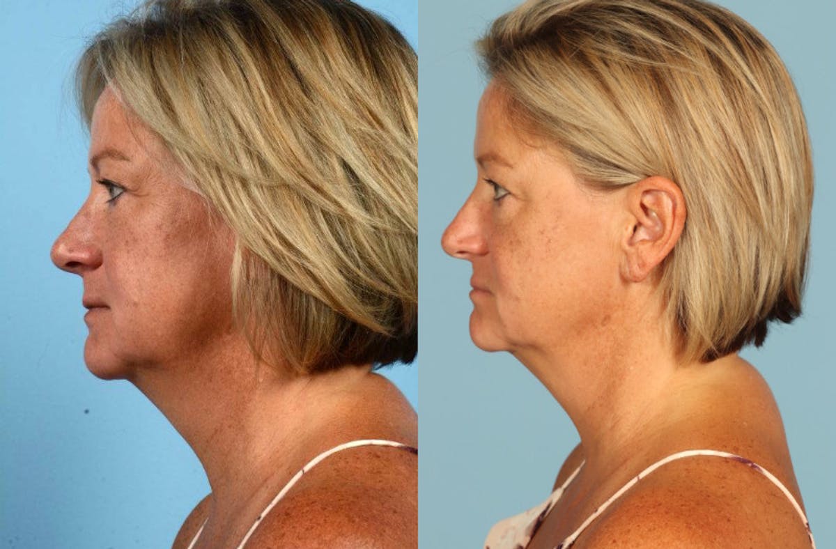 Midface Lift Before & After Gallery - Patient 391939 - Image 4