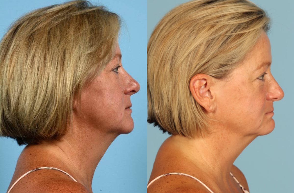 Midface Lift Before & After Gallery - Patient 391939 - Image 5