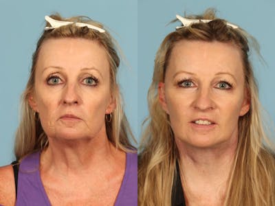 Midface Lift Before & After Gallery - Patient 369285 - Image 1