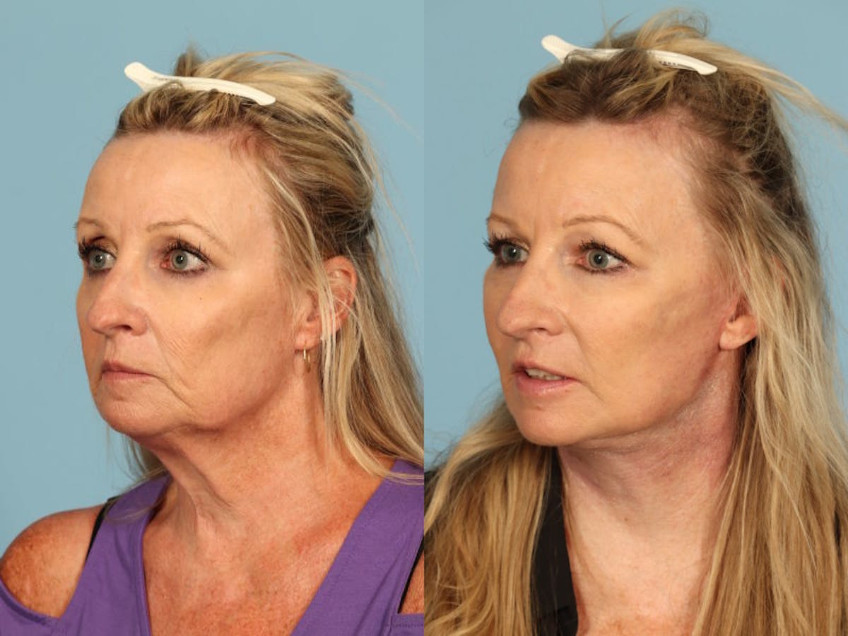 Midface Lift Before & After Gallery - Patient 369285 - Image 2