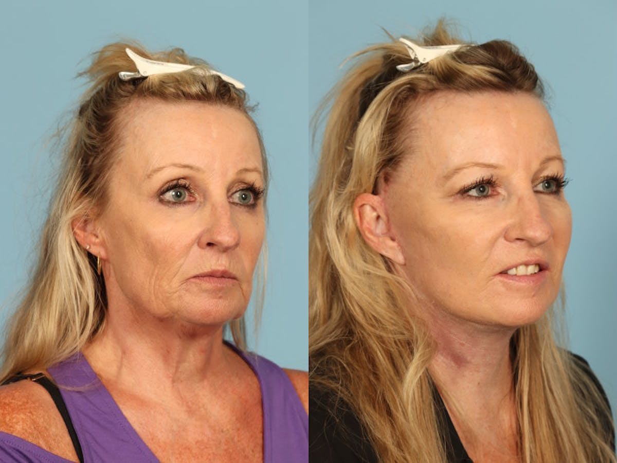 Midface Lift Before & After Gallery - Patient 369285 - Image 3