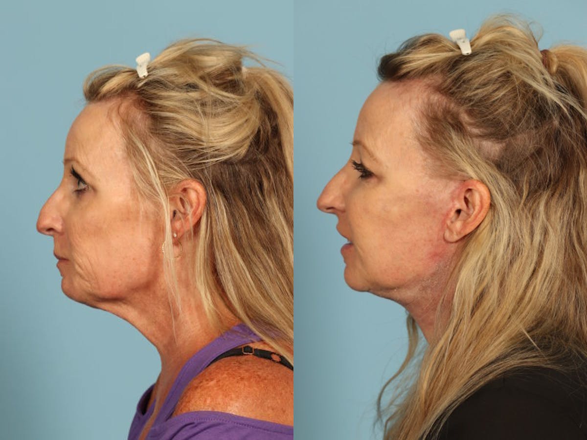 Midface Lift Before & After Gallery - Patient 369285 - Image 4