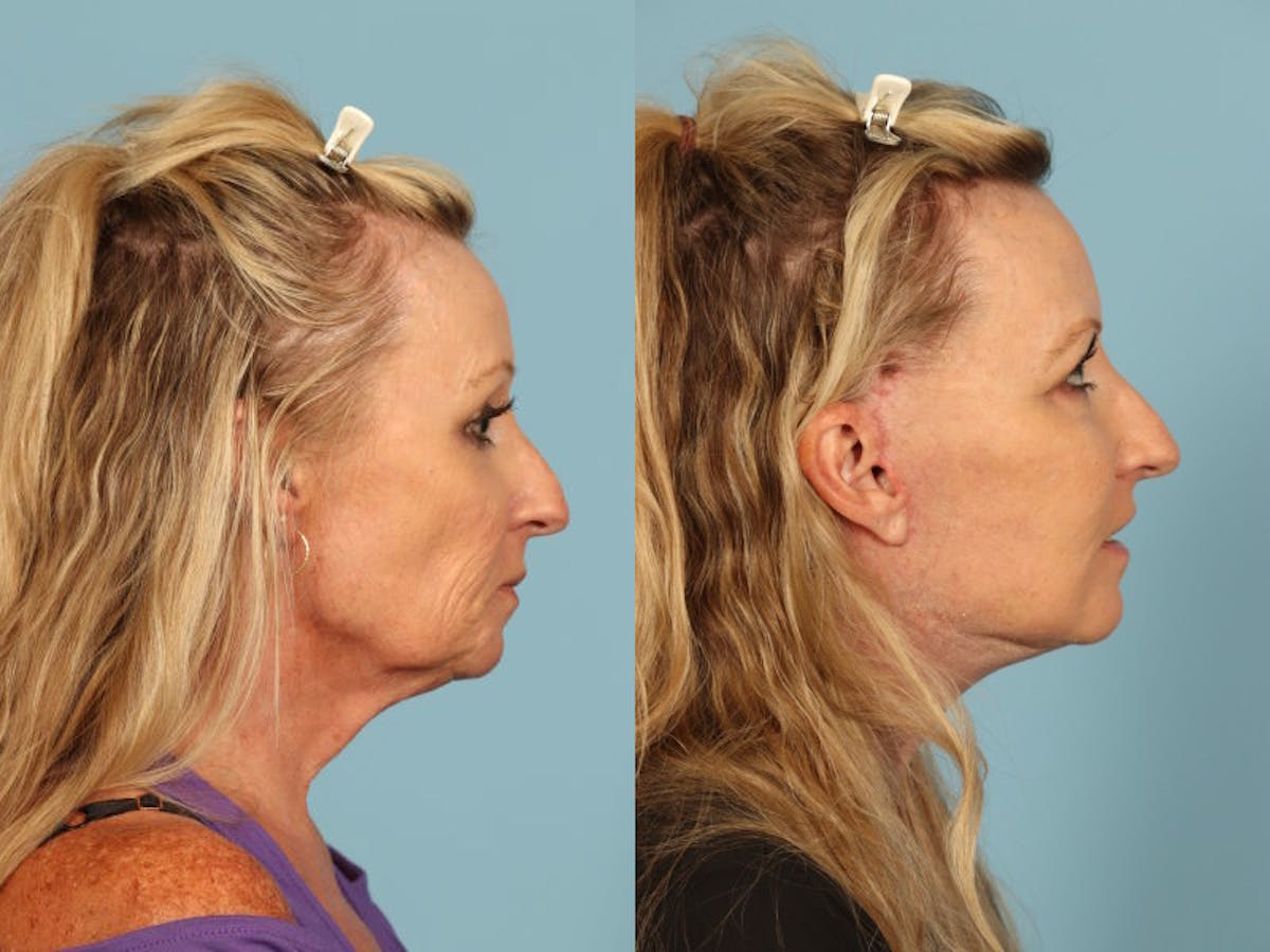 Midface Lift Before & After Gallery - Patient 369285 - Image 5