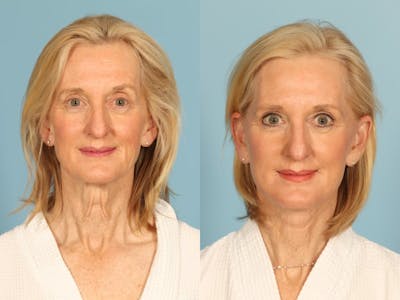 Midface Lift Before & After Gallery - Patient 371424 - Image 1