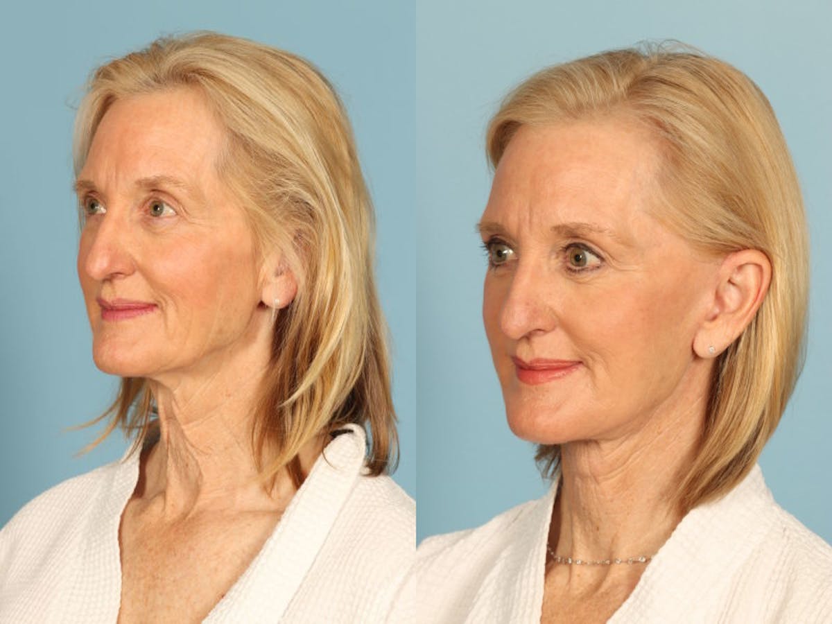 Midface Lift Before & After Gallery - Patient 371424 - Image 2