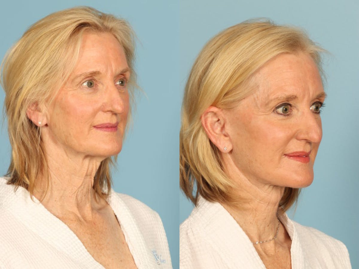 Midface Lift Before & After Gallery - Patient 371424 - Image 3