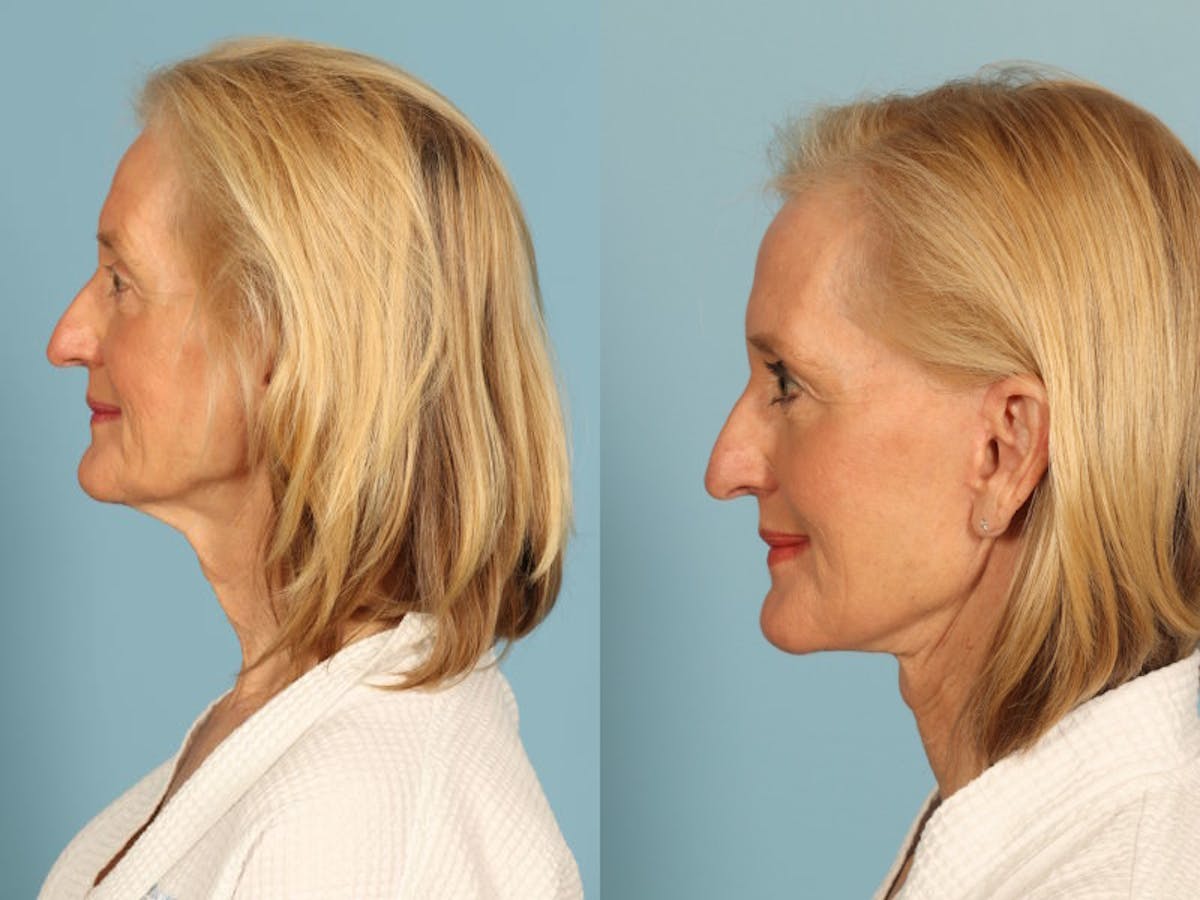 Midface Lift Before & After Gallery - Patient 371424 - Image 4