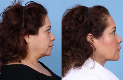 Chin Liposuction Before & After Gallery - Patient 237226 - Image 1
