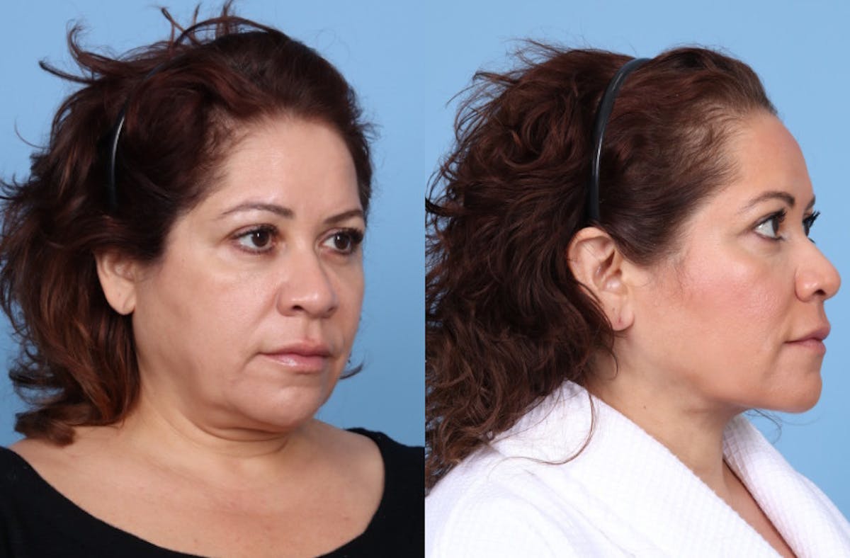Chin Liposuction Before & After Gallery - Patient 237226 - Image 2