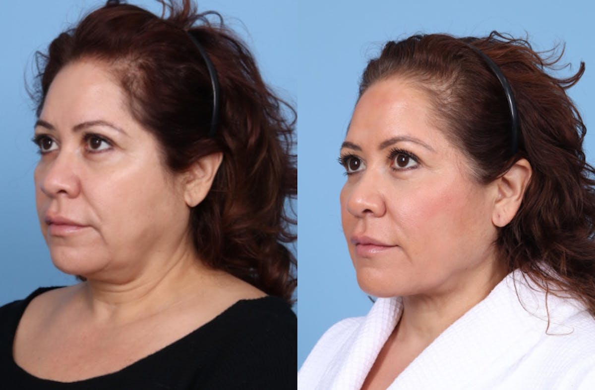 Chin Liposuction Before & After Gallery - Patient 237226 - Image 3