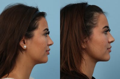 Chin Liposuction Before & After Gallery - Patient 114855 - Image 1