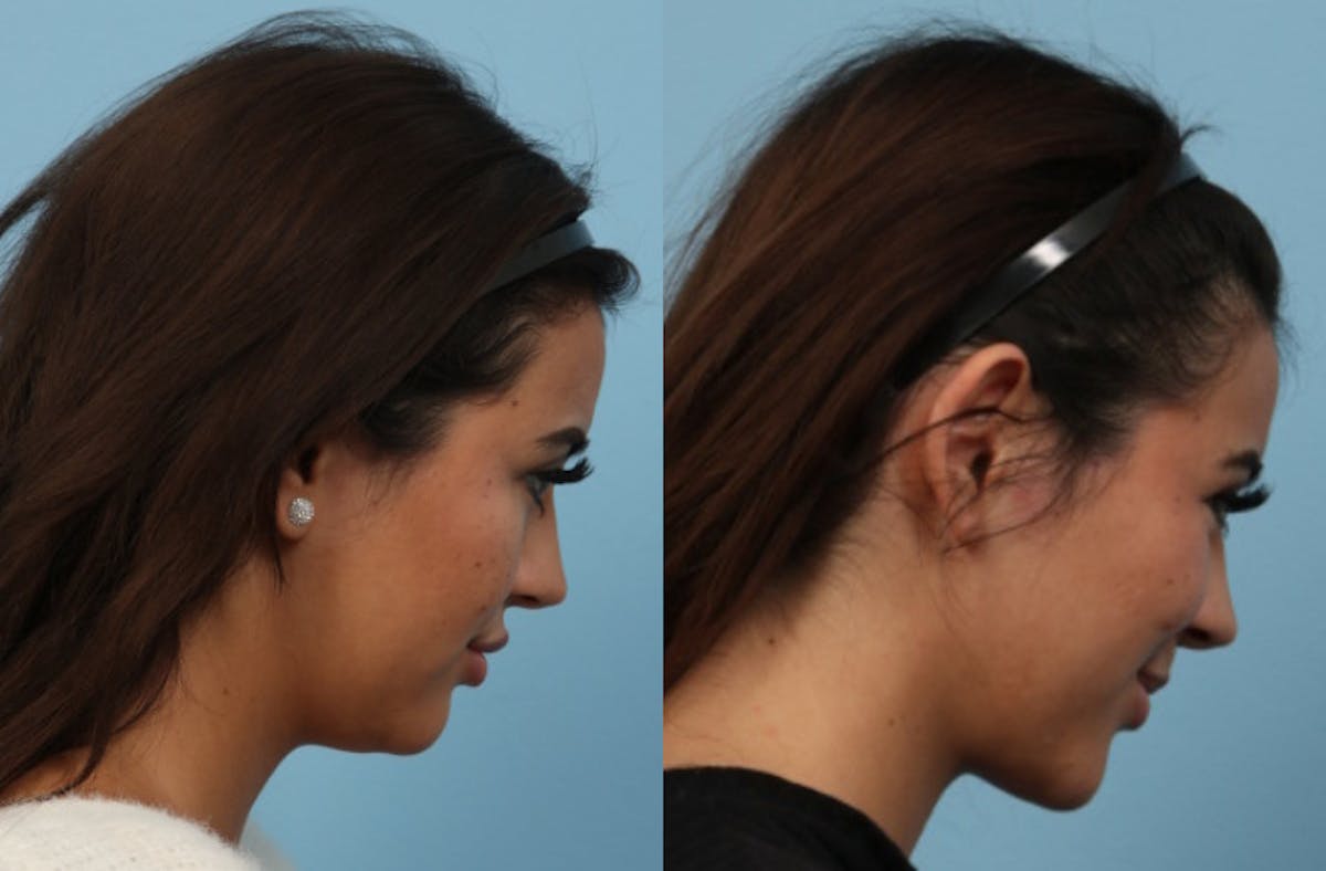 Chin Liposuction Before & After Gallery - Patient 114855 - Image 2