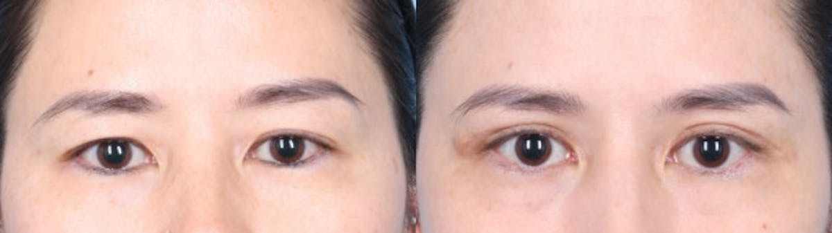 Eyelid Surgery Before & After Gallery - Patient 150179 - Image 1
