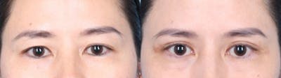 Eyelid Surgery Before & After Gallery - Patient 150179 - Image 1