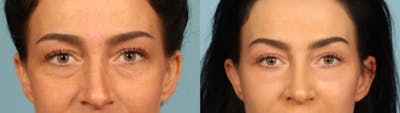 Eyelid Surgery Before & After Gallery - Patient 631126 - Image 1