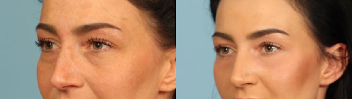 Eyelid Surgery Before & After Gallery - Patient 631126 - Image 2