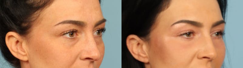 Eyelid Surgery Before & After Gallery - Patient 631126 - Image 3