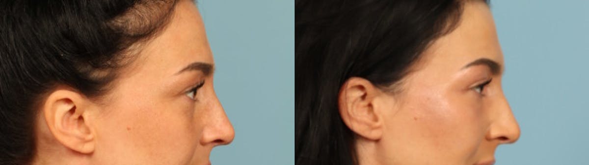 Eyelid Surgery Before & After Gallery - Patient 631126 - Image 4