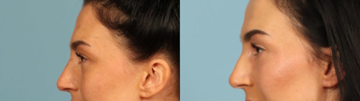 Eyelid Surgery Before & After Gallery - Patient 631126 - Image 5