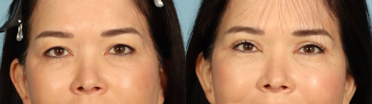 Eyelid Surgery Before & After Gallery - Patient 821845 - Image 1