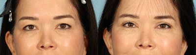 Eyelid Surgery Before & After Gallery - Patient 821845 - Image 1
