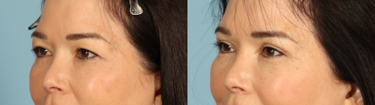 Eyelid Surgery Before & After Gallery - Patient 821845 - Image 2