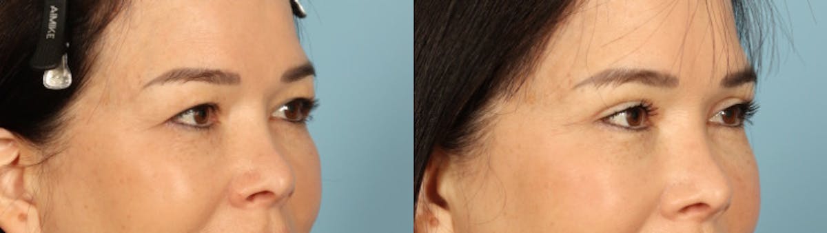 Eyelid Surgery Before & After Gallery - Patient 821845 - Image 3