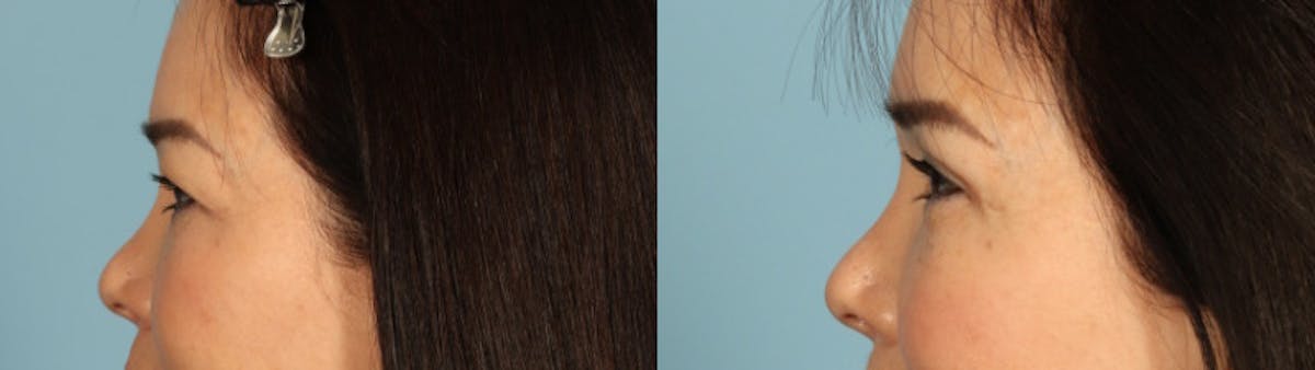Eyelid Surgery Before & After Gallery - Patient 821845 - Image 4
