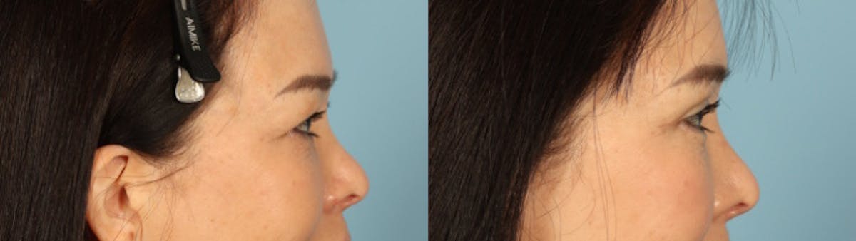 Eyelid Surgery Before & After Gallery - Patient 821845 - Image 5