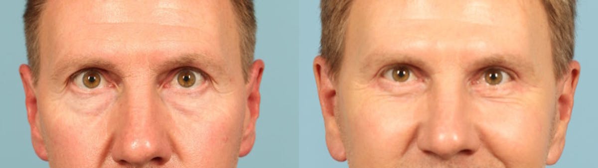 Eyelid Surgery Before & After Gallery - Patient 292514 - Image 1