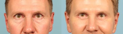 Eyelid Surgery Before & After Gallery - Patient 292514 - Image 1