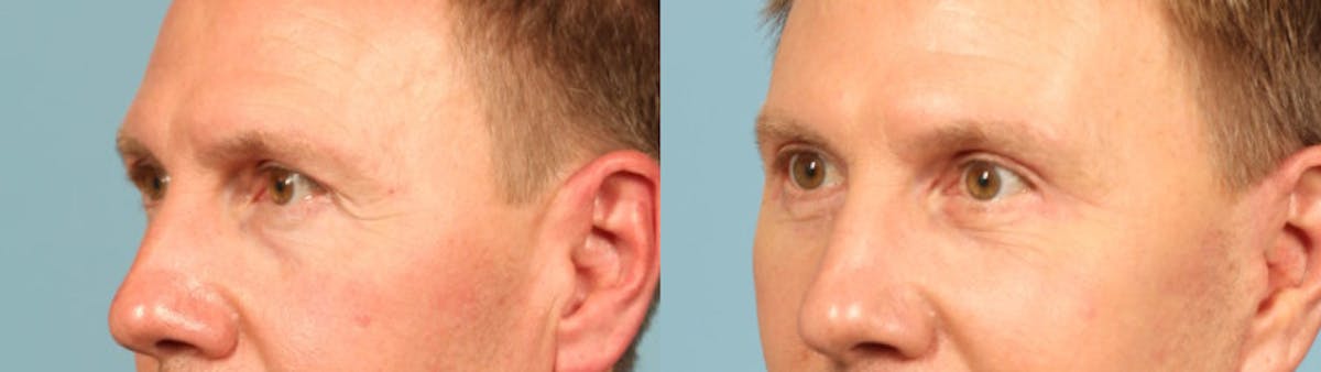 Eyelid Surgery Before & After Gallery - Patient 292514 - Image 2