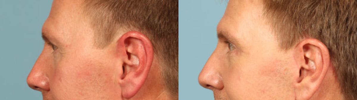 Eyelid Surgery Before & After Gallery - Patient 292514 - Image 3