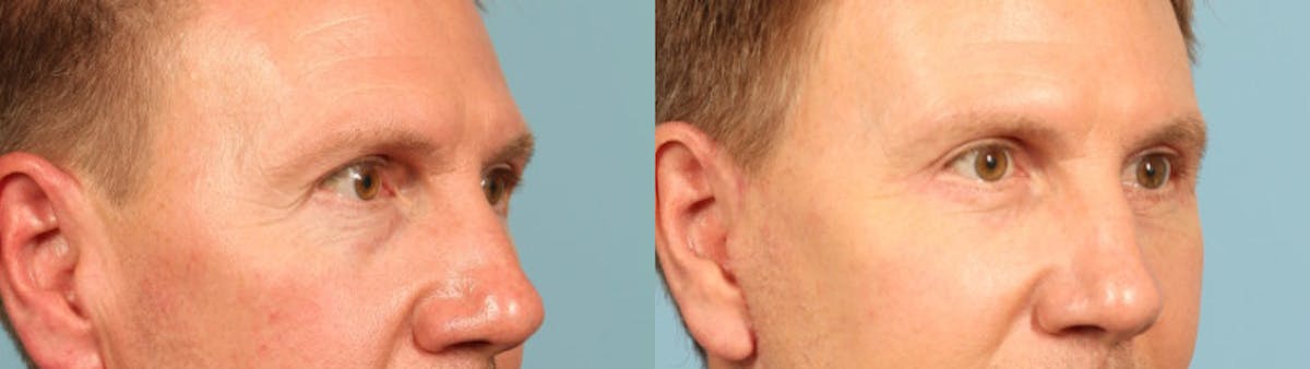 Eyelid Surgery Before & After Gallery - Patient 292514 - Image 4