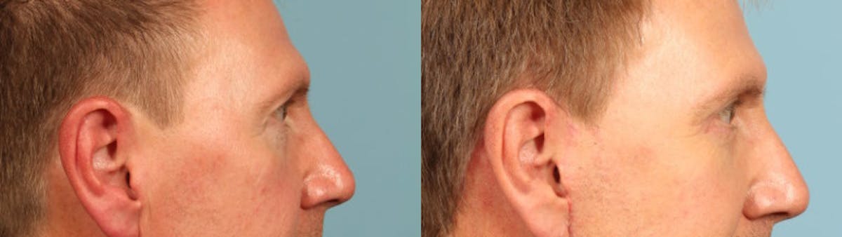 Eyelid Surgery Before & After Gallery - Patient 292514 - Image 5
