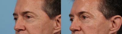 Eyelid Surgery Before & After Gallery - Patient 127180 - Image 1