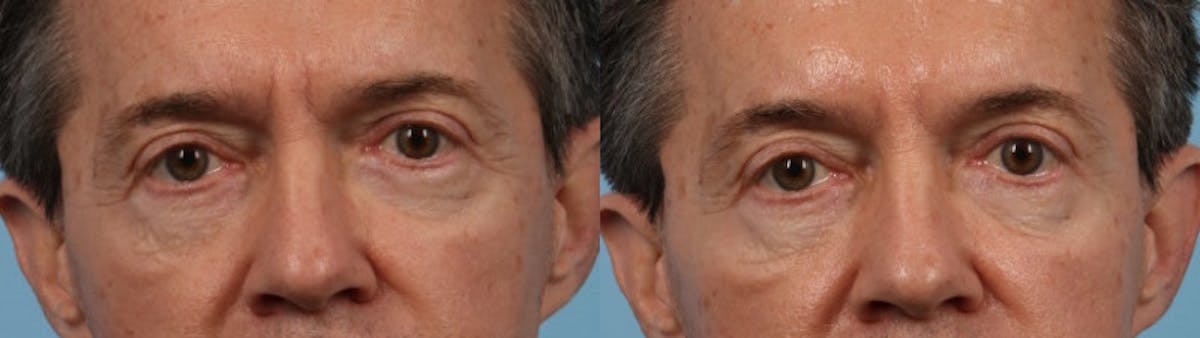 Eyelid Surgery Before & After Gallery - Patient 127180 - Image 2