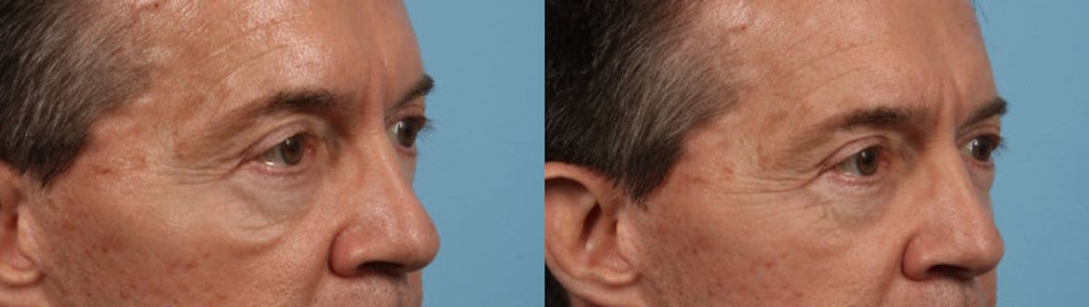 Eyelid Surgery Before & After Gallery - Patient 127180 - Image 3