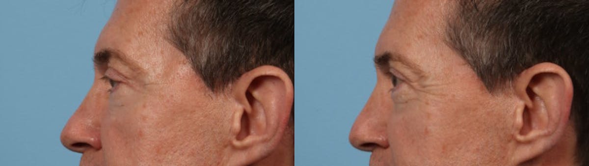 Eyelid Surgery Before & After Gallery - Patient 127180 - Image 4