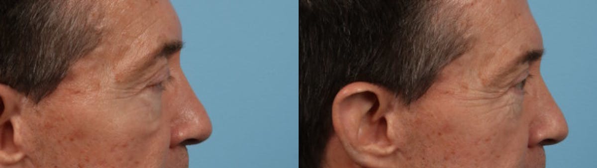 Eyelid Surgery Before & After Gallery - Patient 127180 - Image 5