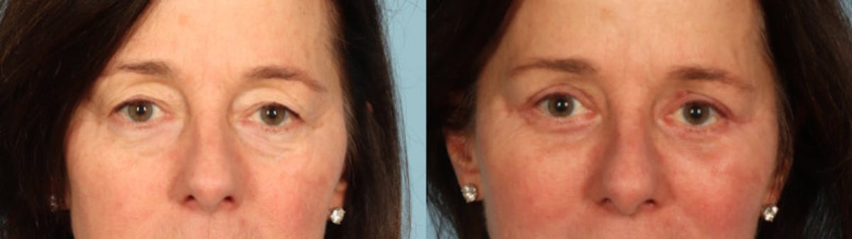 Eyelid Surgery Before & After Gallery - Patient 702467 - Image 1